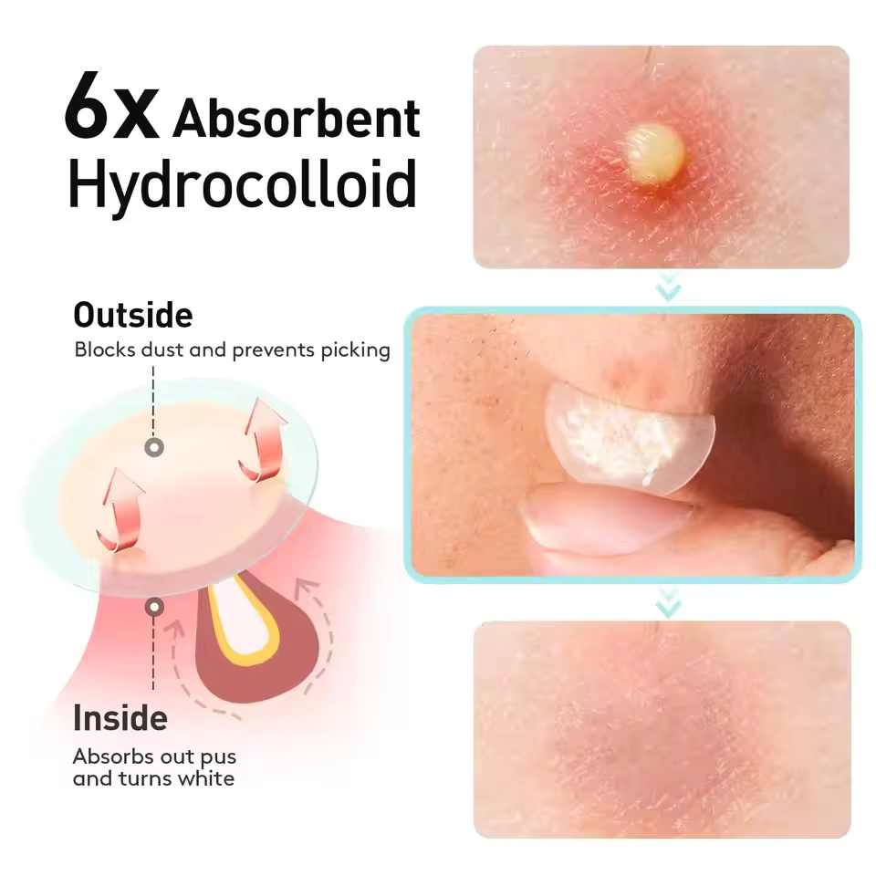 360 stuks/doos acnepleisters - - Essential Oils recensie en prijs
